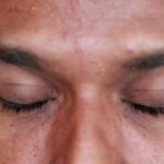 糖尿病視網膜病變 病因、症狀與治療