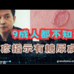 手腳出現這一種皮疹可能有糖尿病或血脂高