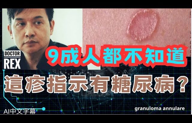 手腳出現這一種皮疹可能有糖尿病或血脂高
