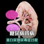 糖尿病腎病，如何從蛋白尿到尿毒症。從大體到微觀帶您瞭解