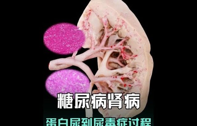 糖尿病腎病，如何從蛋白尿到尿毒症。從大體到微觀帶您瞭解