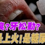 糖尿病症狀  這 10 個身體求救訊號，可能是糖尿病前兆 ~ 口腔 牙 皮膚 酵母菌(別等洗腎才後悔)【納福小站】#喵一下 #養生