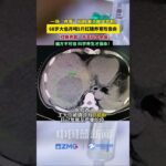 1月18日 据钱江晚报报道，有糖尿病史的68岁杭州大伯因胃部不适听信“红糖养胃”的偏方，1个月喝掉5斤红糖引发肝脓肿。医生解释，糖尿病患者血糖本就偏高，高糖饮食会增加细菌感染风险。无科学依据的