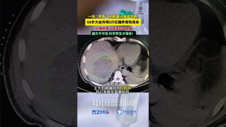 1月18日 据钱江晚报报道，有糖尿病史的68岁杭州大伯因胃部不适听信“红糖养胃”的偏方，1个月喝掉5斤红糖引发肝脓肿。医生解释，糖尿病患者血糖本就偏高，高糖饮食会增加细菌感染风险。无科学依据的