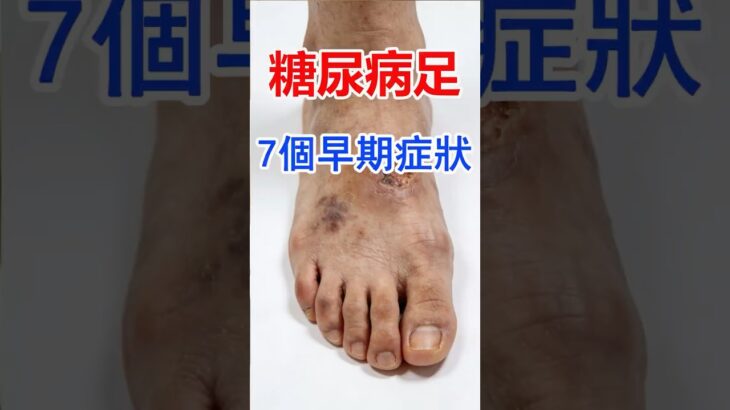 糖尿病足早期症狀自查,腳上出現這7個症狀立刻就醫,晚了要截肢!#糖尿病足 #糖尿病並發症 #足部健康 #中老年