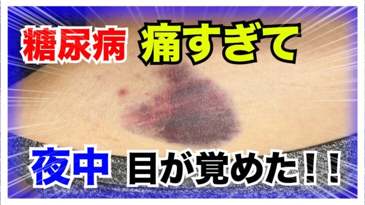 【糖尿病 Type1 】糖尿病痛すぎて夜中目覚める！こんな時は我慢しないでカスタマーへ電話してと言われる！