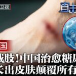 不用截肢！中国治愈糖尿病足！烂脚重新长出皮肤，中国给出方案，再生医学颠覆所有权威认知【科普中国直击最前沿】