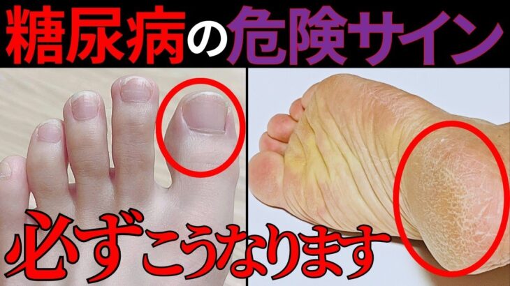 【医師監修】絶対に見逃すな！糖尿病で起こりやすい「足の危険サイン」と症状・予防法を徹底解説