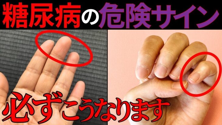 【医師監修】見逃すと危険！「手」に現れる糖尿病の重要サインとは？症状から予防法まで徹底解説