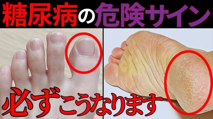 【医師監修】見逃すと危険…糖尿病の初期サインとは？症状・原因・今日からできる予防法をわかりやすく解説