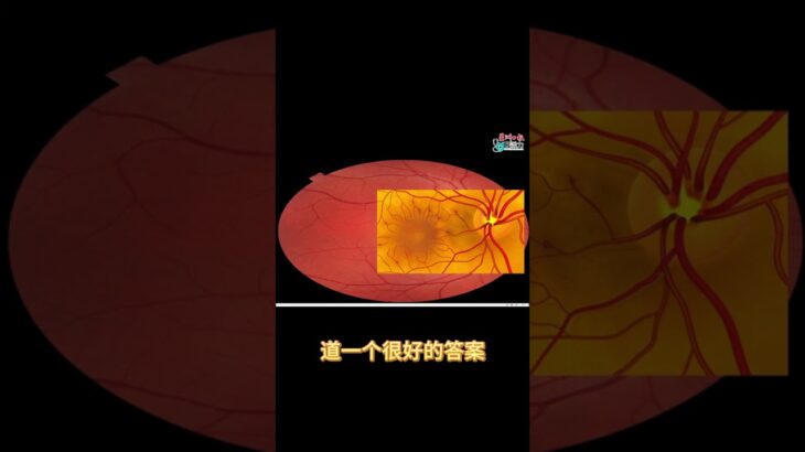 血管漏水漏血漏油，糖尿病视网膜病变！ #医识力