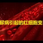 不得不防！糖尿病引发的次生伤害 【科学养生】19
