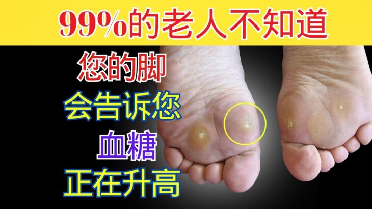 脚部发出的9个糖尿病警示信号