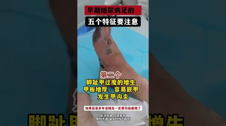 早期糖尿病足有这五大症状，一定要注意,健康养生,疾病治疗