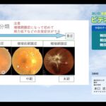 糖尿病網膜症と軽症でも視力低下する糖尿病黄斑症