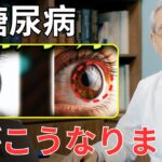 放置すると失明リスク知らないと危険な糖尿病の「目」の初期症状とは？かすみ・ゆがみ・飛蚊症…見逃せないサインと簡単セルフチェック＆最新治療を医師が解説｜高齢者の健康