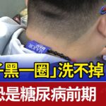 「脖子黑一圈」洗不掉 醫：恐是糖尿病前期