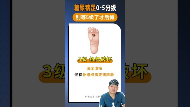 糖尿病足0-5分级，别等5级了才后悔！ #糖尿病 #糖尿病足 #臭脚 #足部感染 #截肢