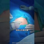 23岁小姑娘妊娠期糖尿病，没有羊水了，选择剖腹产#孕期 #顺产 #糖尿病 #分娩 #妇产科郭莉医生