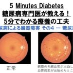 糖尿病専門医が教える！5分でわかる療養の工夫　第9回　糖尿病による臓器障害 その4 ― 糖尿病性網膜症（目の合併症）　5 Minutes Diabetes: Retinopathy（Eye)