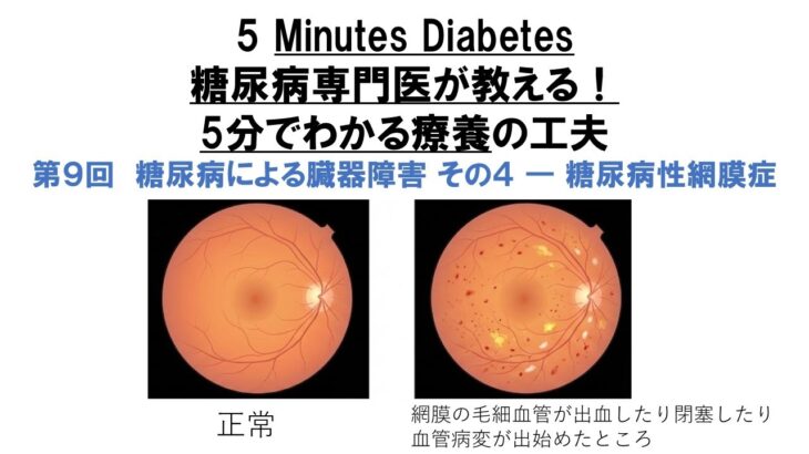 糖尿病専門医が教える！5分でわかる療養の工夫　第9回　糖尿病による臓器障害 その4 ― 糖尿病性網膜症（目の合併症）　5 Minutes Diabetes: Retinopathy（Eye)
