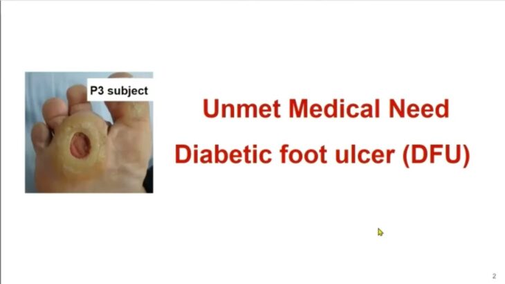 糖尿病患者足部出現潰瘍(DFU_Diabetic Foot Ulcer)速必一乳膏