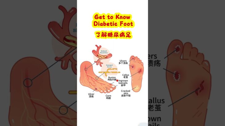 Get to Know Diabetic Foot 了解糖尿病足