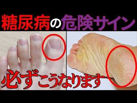 【医師監修】知らないと後悔する糖尿病の危険サイン！症状から予防法まで徹底解説