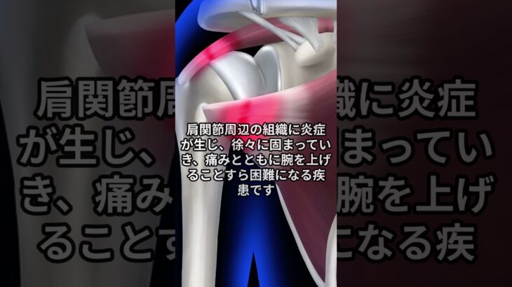 糖尿病患者、「肩」に気をつけろと言うけれど…なぜ？  #健康 #糖尿病 #五十肩