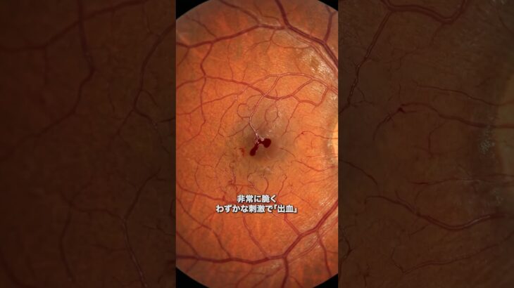 見えているのに失明する…糖尿病網膜症を放置した結果