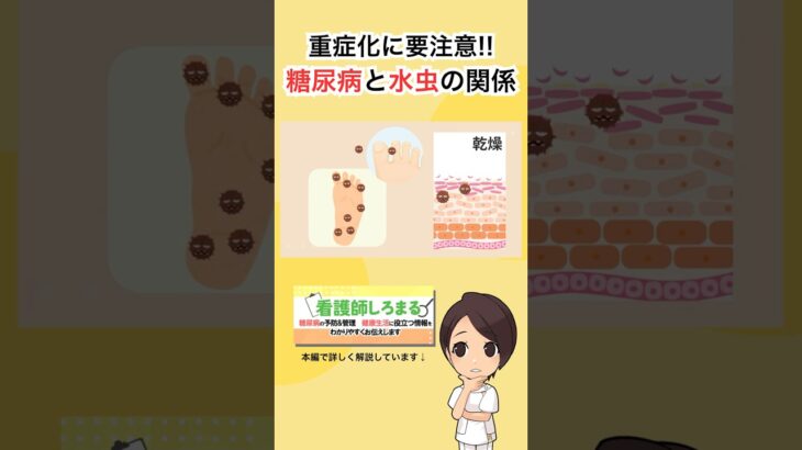 ［糖尿病］かゆくない水虫が足切断のリスクを高める