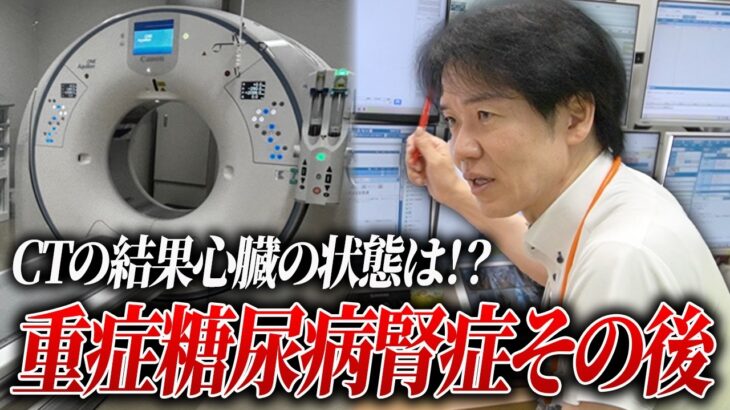 尿蛋白25グラムだった重症糖尿病腎症患者/懸念される心臓CTの結果は？【べっぷ内科】