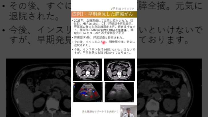 画像からの早期発見：膵臓がん #糖尿病専門医 #多田クリニック #腎臓病 #倉敷 #糖尿病 #生活習慣病 #hba1c #マンジャロ