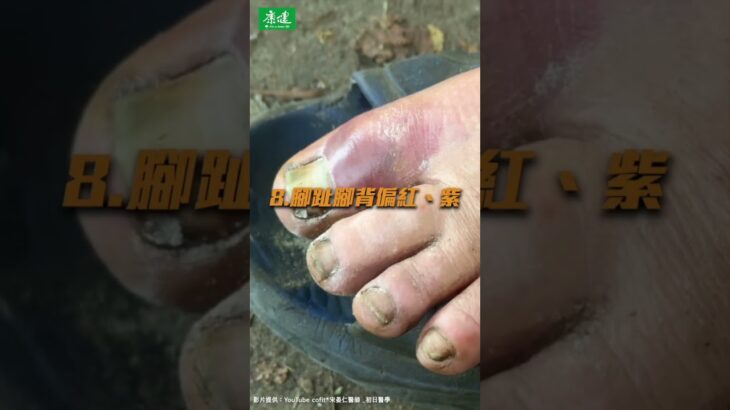 醫列「15大糖尿病隱形警訊」：腳跟龜裂、視力忽模糊都要小心  @Cofit211  ｜康健雜誌