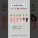 糖尿病足發展過程，千萬不要拖到截肢的地步！ #糖尿病足 #糖尿病 #高血糖