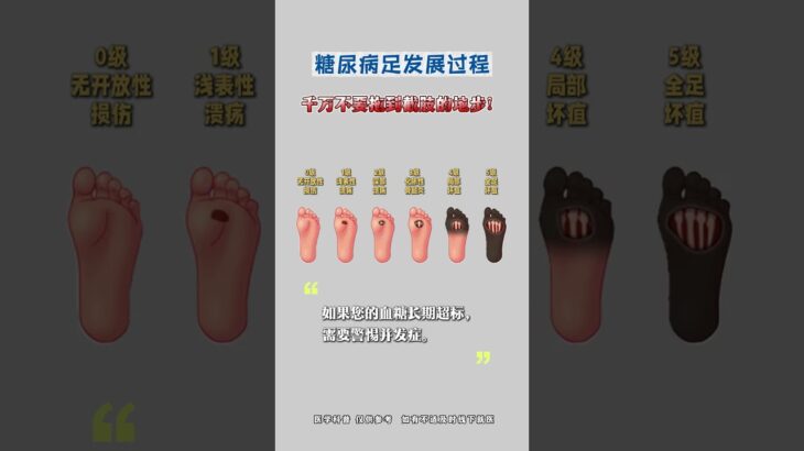 糖尿病足發展過程，千萬不要拖到截肢的地步！ #糖尿病足 #糖尿病 #高血糖