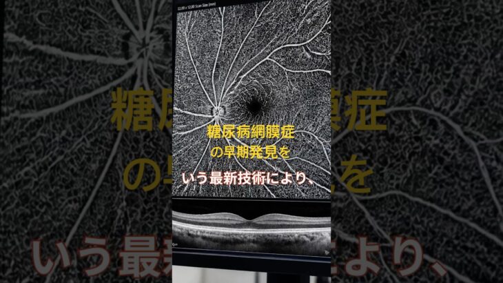 糖尿病と診断されたら眼科受診を。#糖尿病網膜症