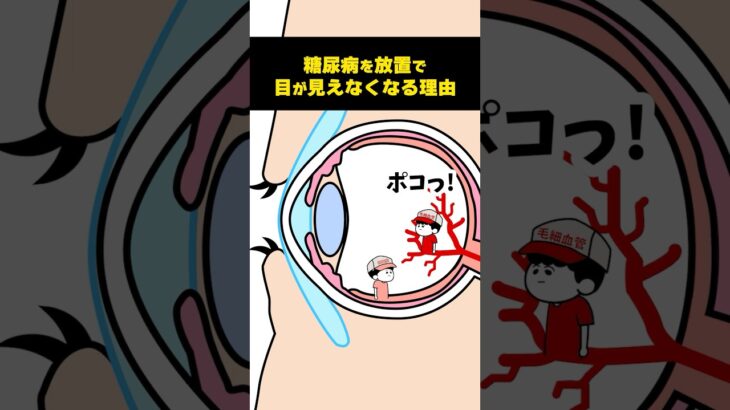 糖尿病の合併症で視力を失うしくみ【アニメ】