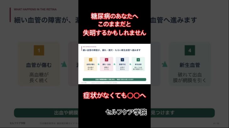 症状がなくても安心できない。糖尿病網膜とは？