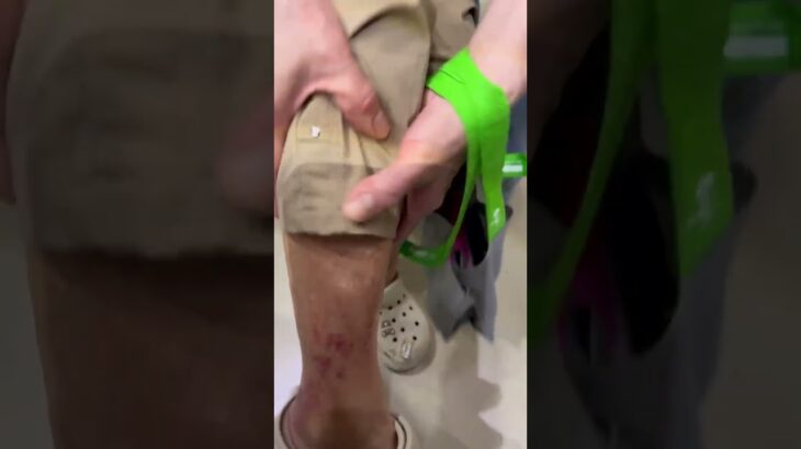 蜂窩性組織炎 好發於老人、糖尿病人的下肢 循環不好  鏈球菌感染 非常注意