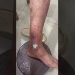 糖尿病足、褥瘡傷口換藥十分謹慎傷口或患部照顧原則@333換藥 三消三抹三次（每日最佳）@依次舖上石臘 -藥膏 -紗布-保鮮膜（增加濕度溫度、有效度）佐以人工皮時 ，有滲透物速換皮為佳 26082302