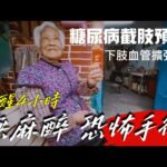 無麻醉4小時恐怖手術！糖尿病截肢前搶救「下肢血管擴張術」