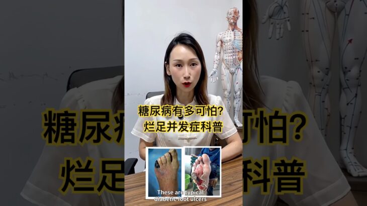 学会控糖，预防足部溃烂。#DiabeticFoot #糖尿病科普 #控糖知识 #糖尿病预防 #血糖管理 #健康科普 #diabetesprevention