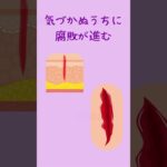 痛みを感じないのは怖い　＃shorts　＃痛覚の消失　＃糖尿病性神経障害　＃糖尿病性足病変　＃フットケア　＃合併症予防