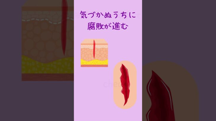 痛みを感じないのは怖い　＃shorts　＃痛覚の消失　＃糖尿病性神経障害　＃糖尿病性足病変　＃フットケア　＃合併症予防