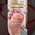 糖尿病人傷口不好癒合，博愛曙光有妙招，非遺針灸+中藥調理！#非遺中醫 #血糖高 #針灸 #中醫 #醫學科普 #大灣區 #北上就醫 #深圳中醫