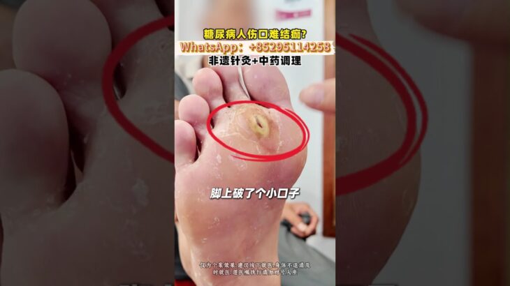糖尿病人傷口不好癒合，博愛曙光有妙招，非遺針灸+中藥調理！#非遺中醫 #血糖高 #針灸 #中醫 #醫學科普 #大灣區 #北上就醫 #深圳中醫