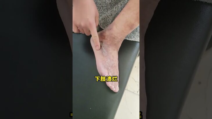 #周圍血管科 #血管外科 #下肢動脈硬化閉塞 #糖尿病足