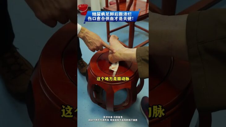 糖尿病足腳後跟潰爛，傷口癒合供血纔是關鍵！ #糖尿病足 #糖尿病