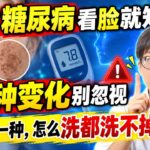 有没有糖尿病看脸就知道？这7种变化别忽视，尤其这一种，怎么洗都洗不掉！【安澜谈健康】#糖尿病 #糖尿病前期 #胰岛素抵抗 #黑棘皮病 #皮肤信号 #脖子发黑 #皮赘 #睑黄瘤 #口渴尿多 #伤口难愈合